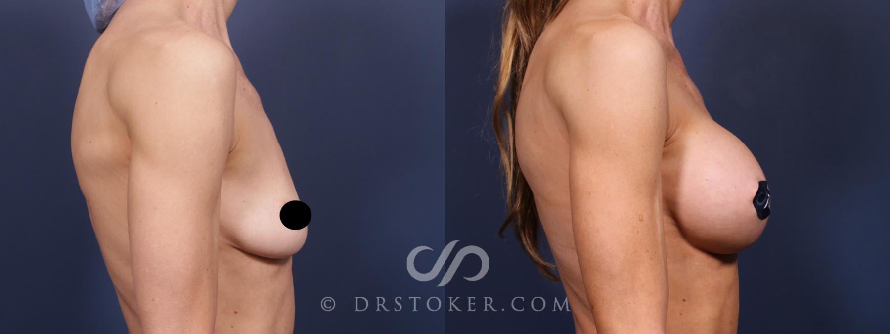 Before & After Breast Augmentation, Rapid Recovery Case 2593 Right Side View in Los Angeles, CA