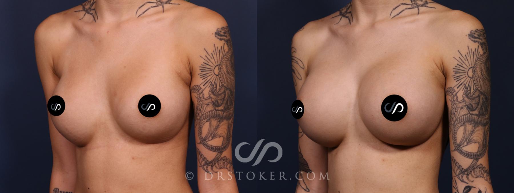 Before & After Breast Augmentation, Rapid Recovery Case 2625 Left Oblique View in Los Angeles, CA