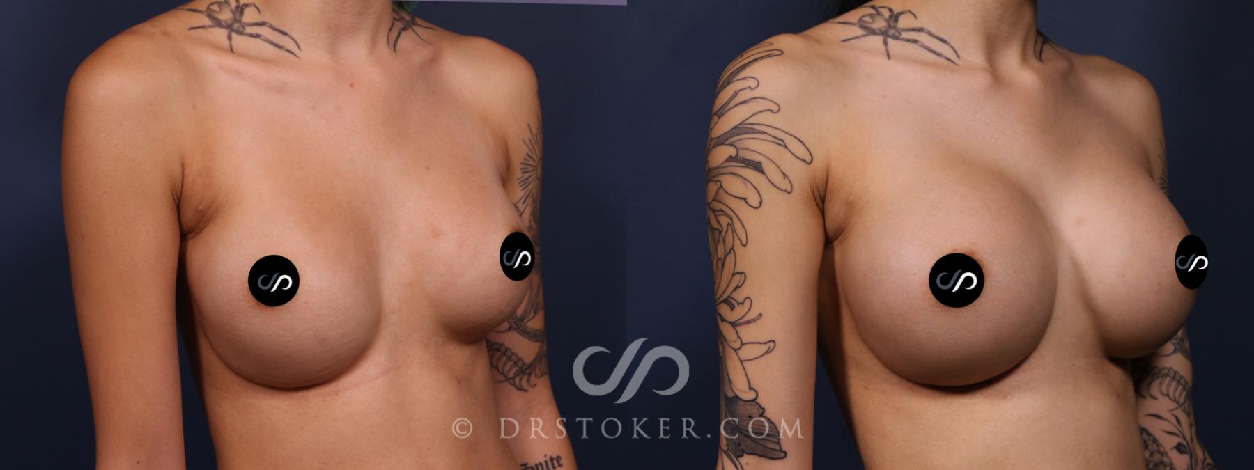 Before & After Breast Augmentation, Rapid Recovery Case 2625 Right Oblique View in Los Angeles, CA