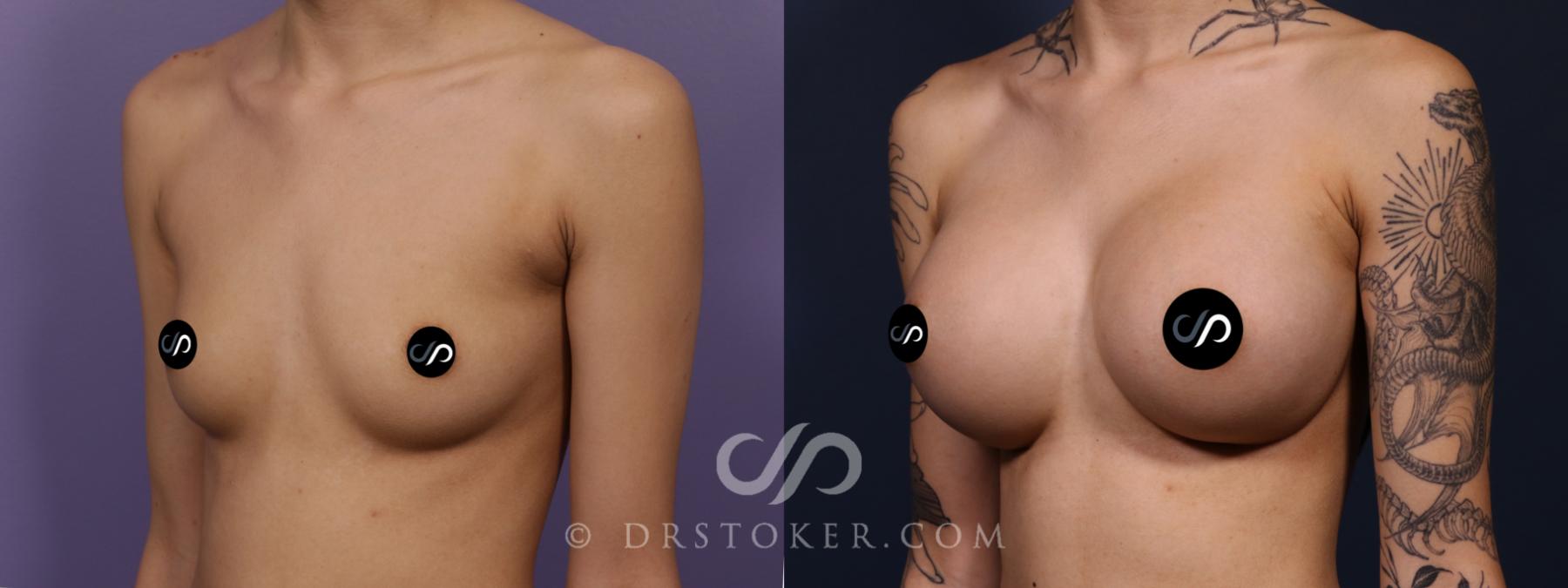 Before & After Breast Augmentation, Rapid Recovery Case 2626 Left Oblique View in Los Angeles, CA