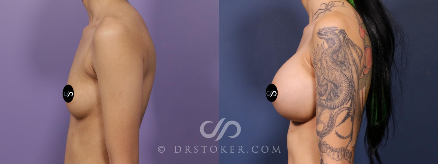 Before & After Breast Augmentation, Rapid Recovery Case 2626 Left Side View in Los Angeles, CA
