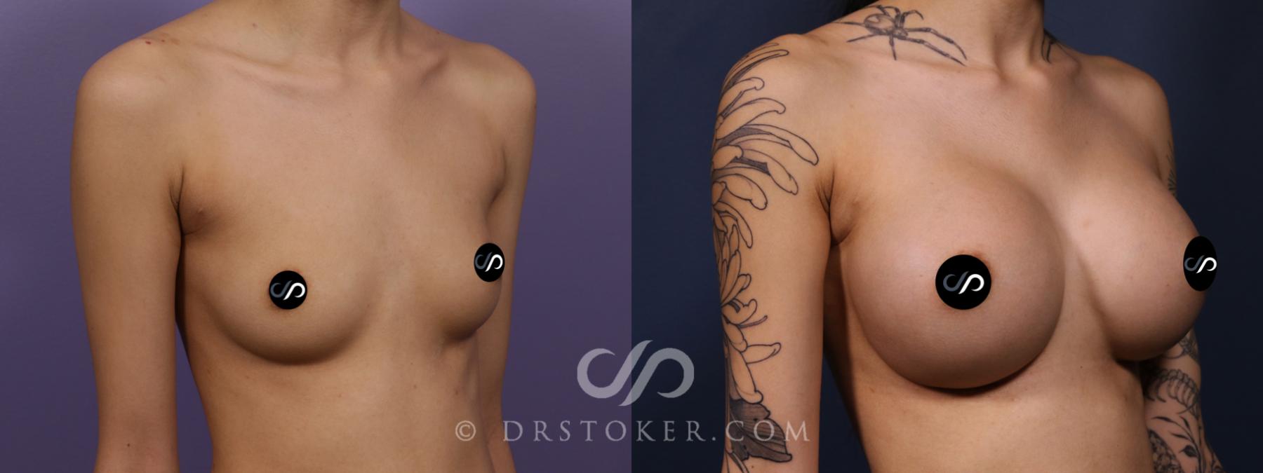 Before & After Breast Augmentation, Rapid Recovery Case 2626 Right Oblique View in Los Angeles, CA