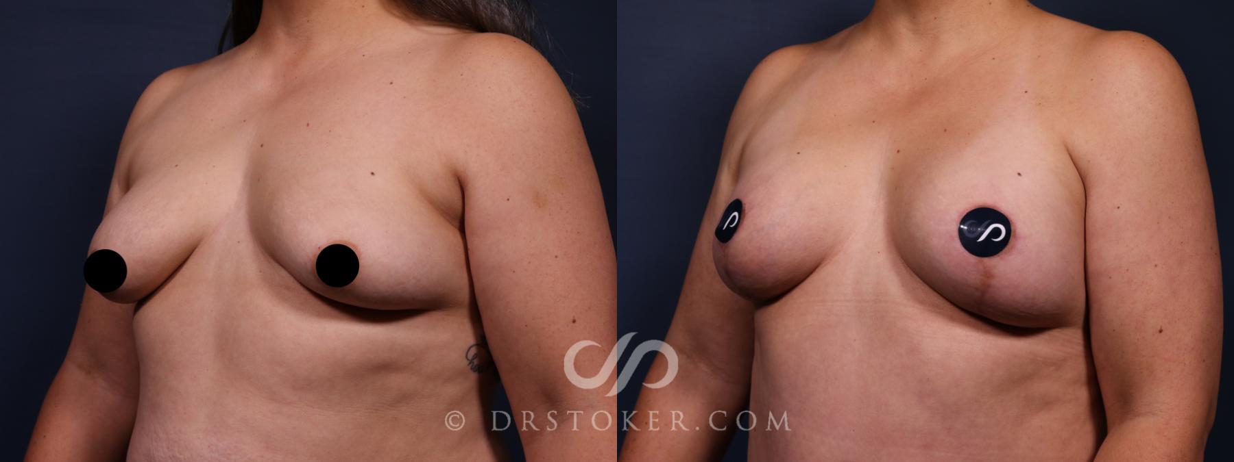 Before & After Breast Augmentation, Rapid Recovery Case 2655 Left Oblique View in Los Angeles, CA