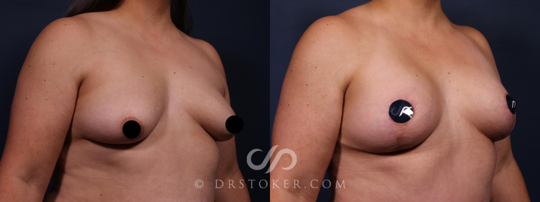 Before & After Breast Augmentation, Rapid Recovery Case 2655 Right Oblique View in Los Angeles, CA