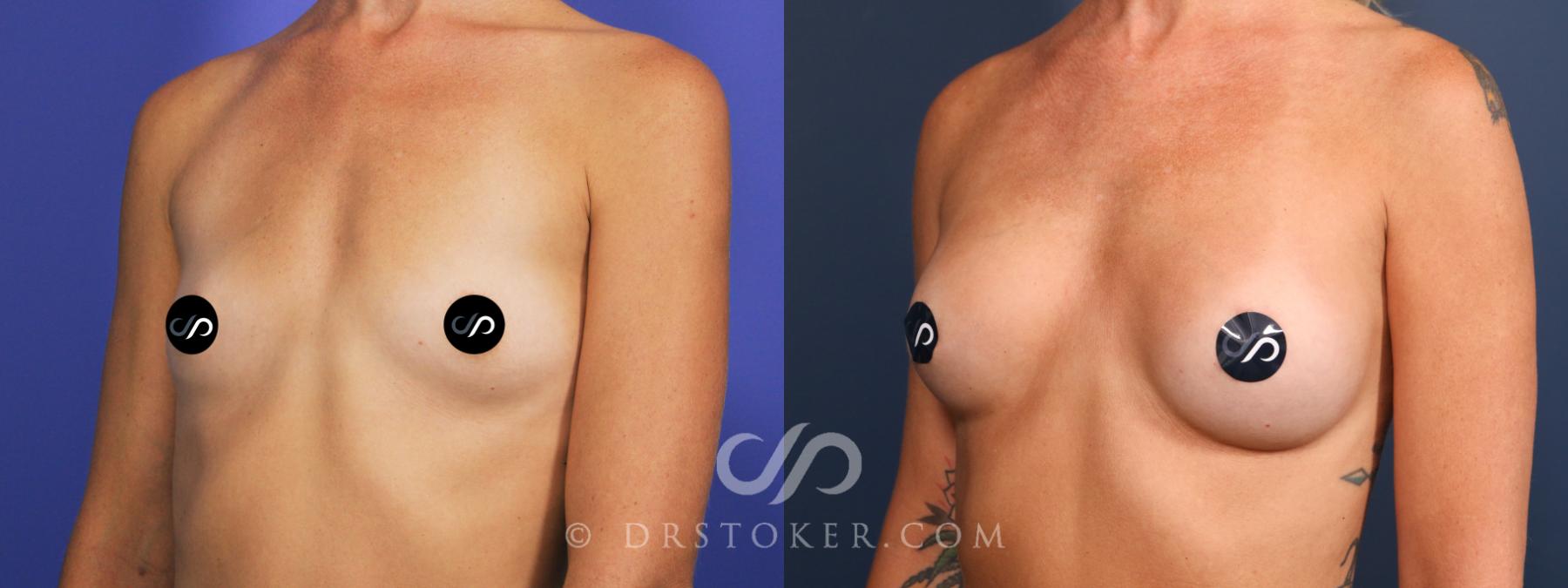 Before & After Breast Augmentation, Rapid Recovery Case 2674 Left Oblique View in Los Angeles, CA