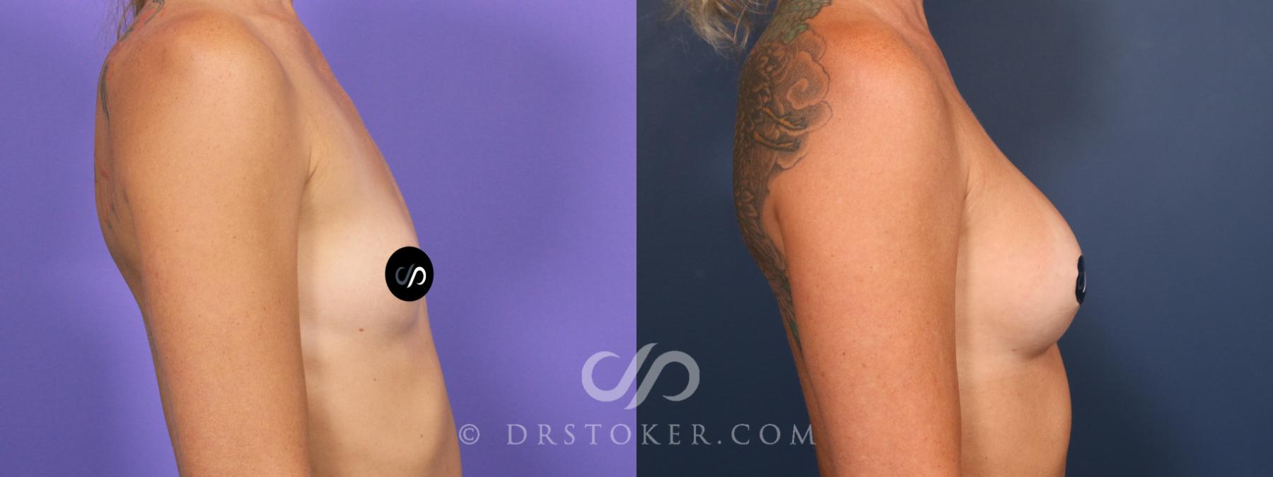 Before & After Breast Augmentation, Rapid Recovery Case 2674 Left Side View in Los Angeles, CA