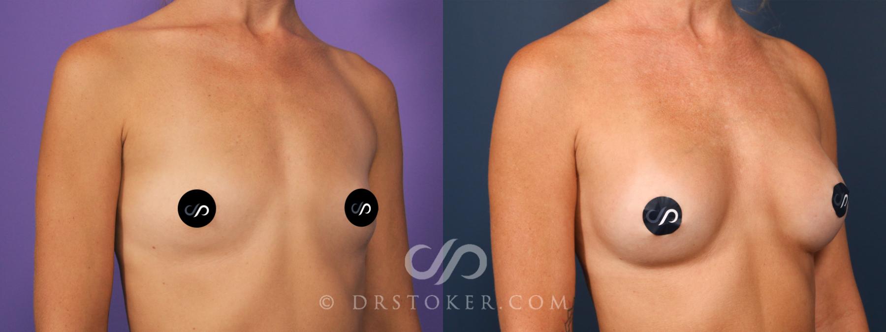 Before & After Breast Augmentation, Rapid Recovery Case 2674 Right Oblique View in Los Angeles, CA
