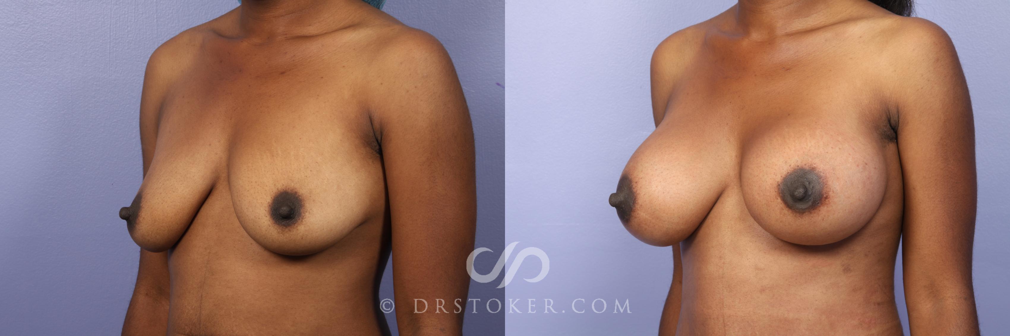 Before & After Breast Augmentation, Rapid Recovery Case 450 View #2 View in Los Angeles, CA