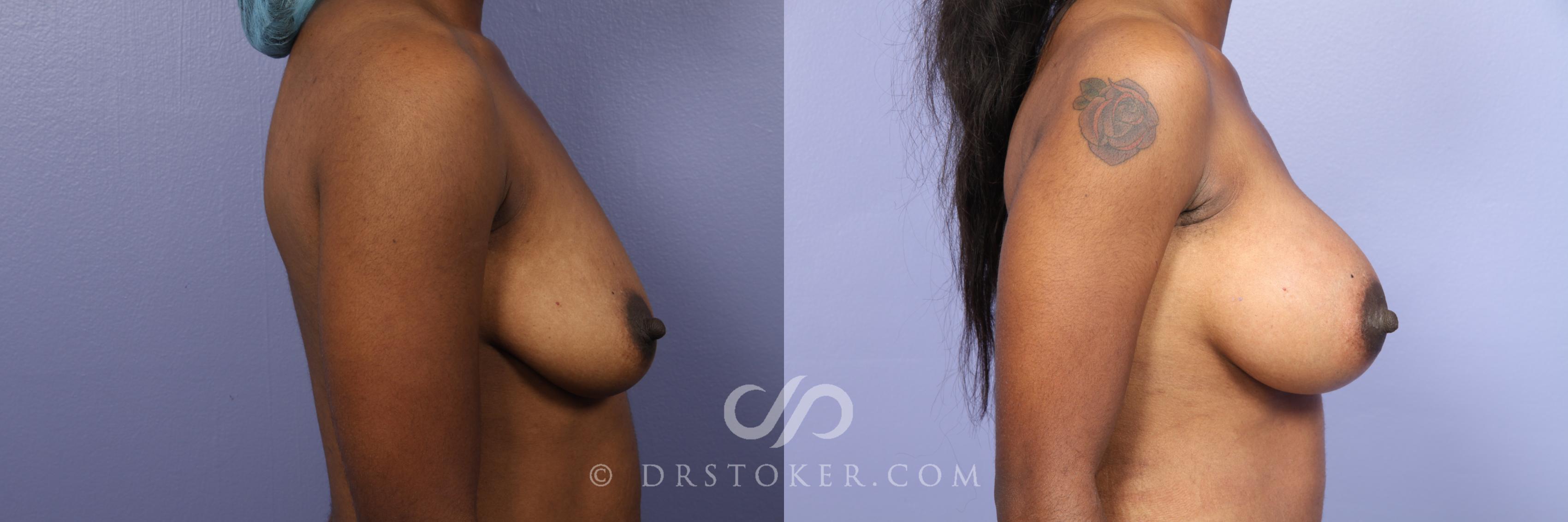 Before & After Breast Asymmetry Correction Case 450 View #5 View in Los Angeles, CA