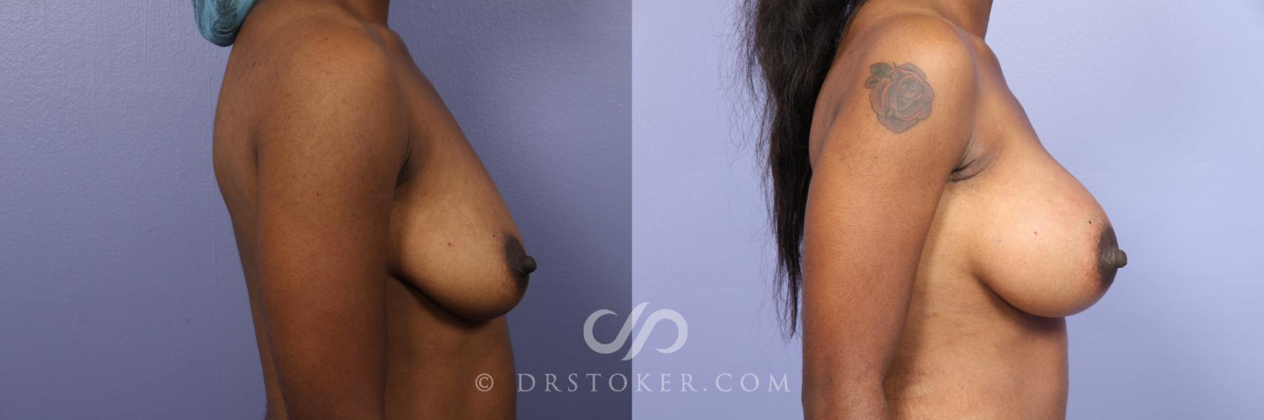 Before & After Breast Augmentation, Rapid Recovery Case 450 View #5 View in Los Angeles, CA