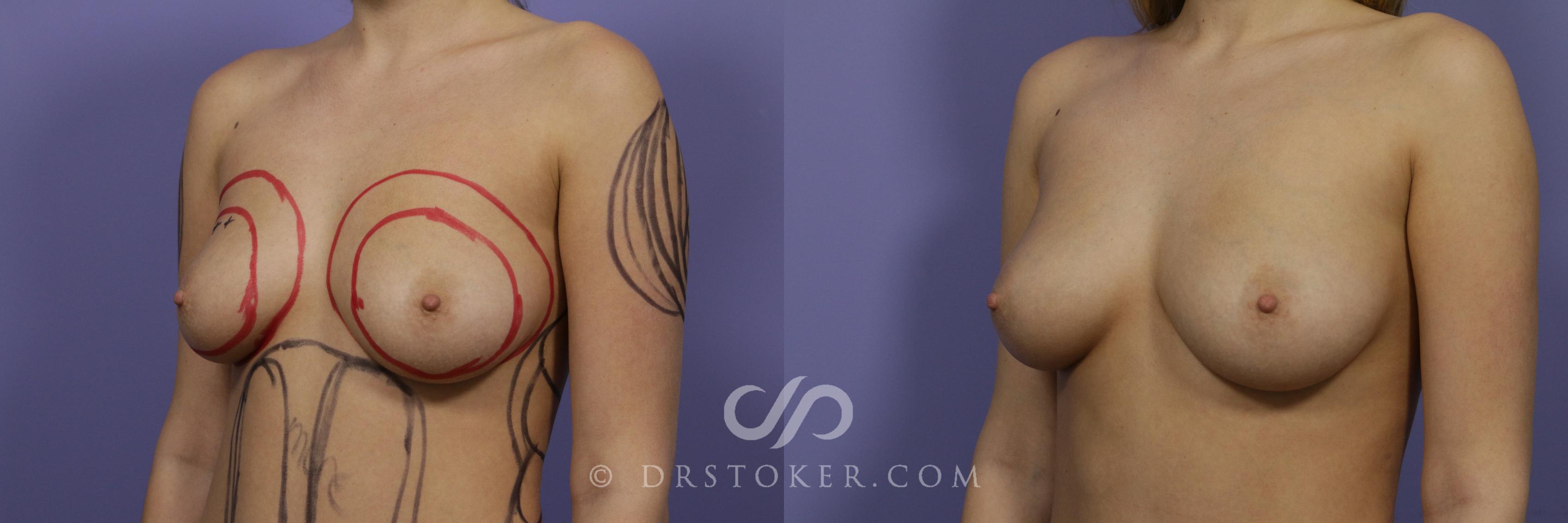 Before & After Breast Augmentation with Fat Grafts Case 1235 View #2 View in Los Angeles, CA