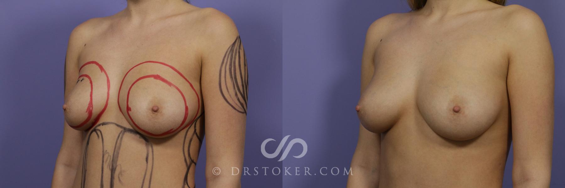 Before & After Breast Augmentation with Fat Grafts Case 1235 View #2 View in Los Angeles, CA