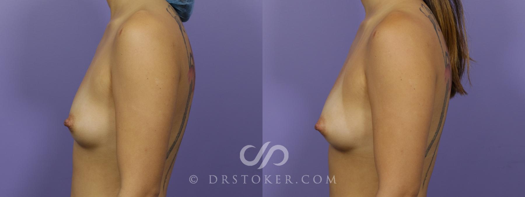 Before & After Breast Augmentation with Fat Grafts Case 1244 View #2 View in Los Angeles, CA