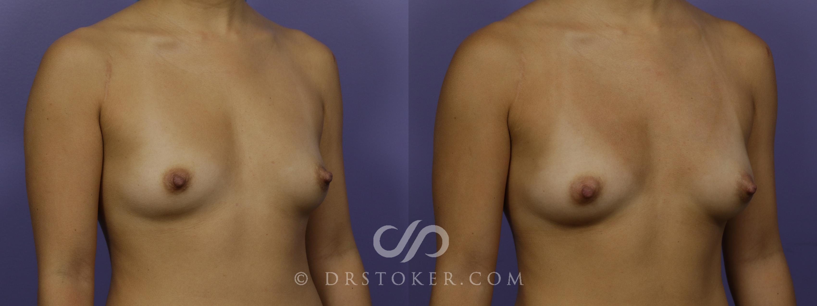Before & After Breast Augmentation with Fat Grafts Case 1245 View #1 View in Marina del Rey, CA