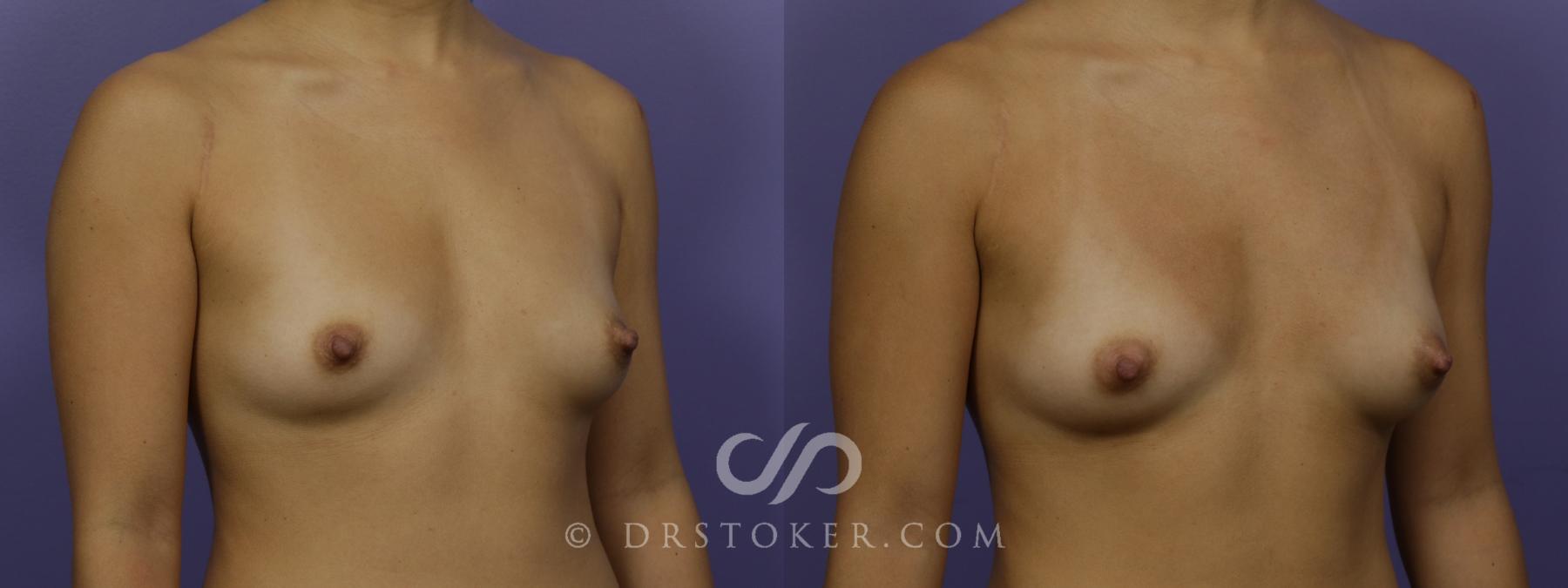 Before & After Breast Augmentation with Fat Grafts Case 1245 View #1 View in Los Angeles, CA
