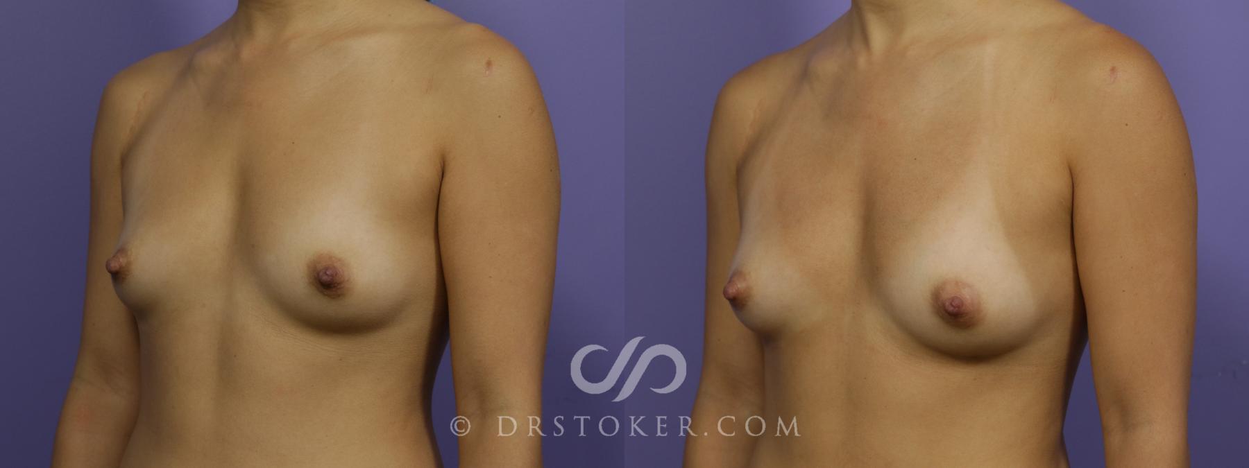 Before & After Breast Augmentation with Fat Grafts Case 1245 View #2 View in Los Angeles, CA