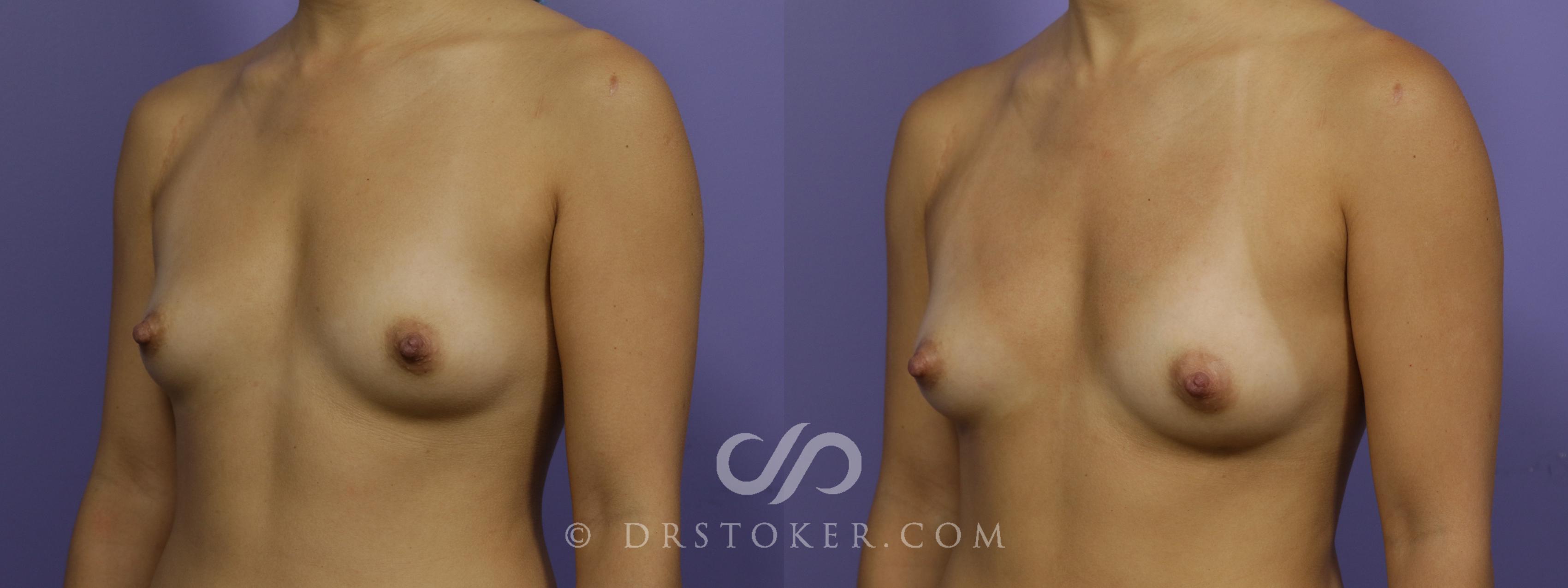 Before & After Breast Augmentation with Fat Grafts Case 1515 View #1 View in Marina del Rey, CA