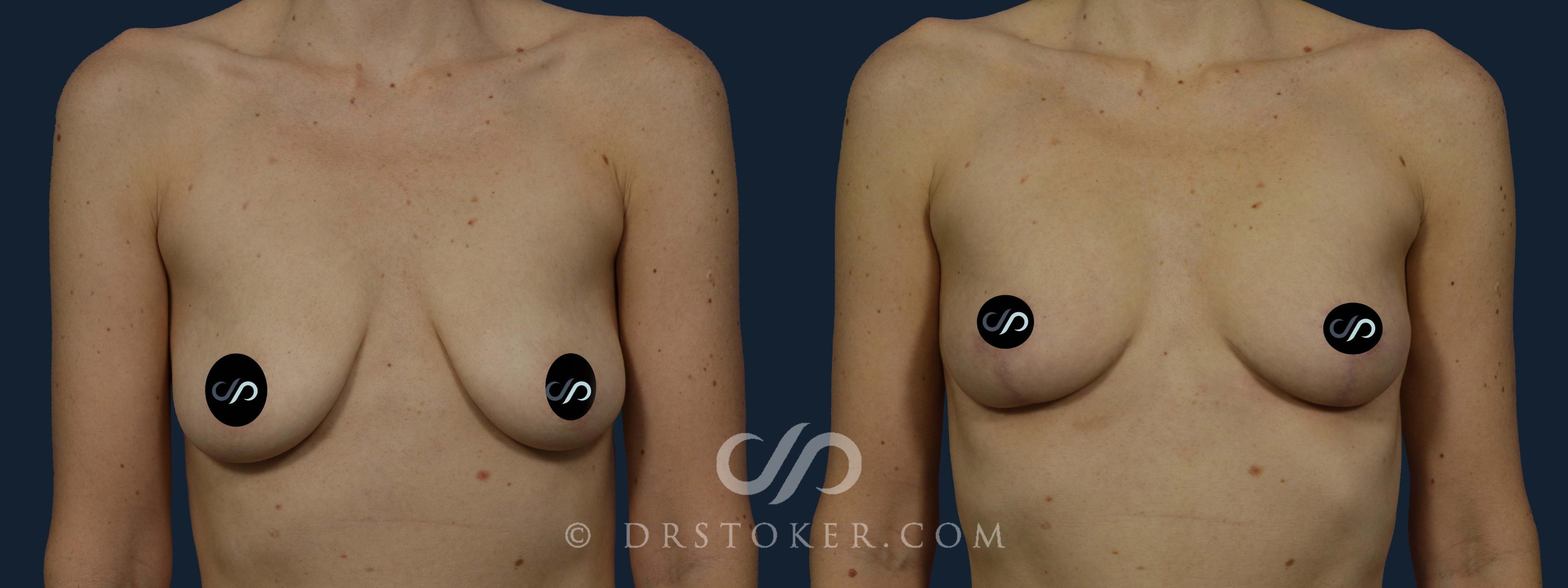 Before & After Breast Augmentation with Fat Grafts Case 1935 Front View in Los Angeles, CA