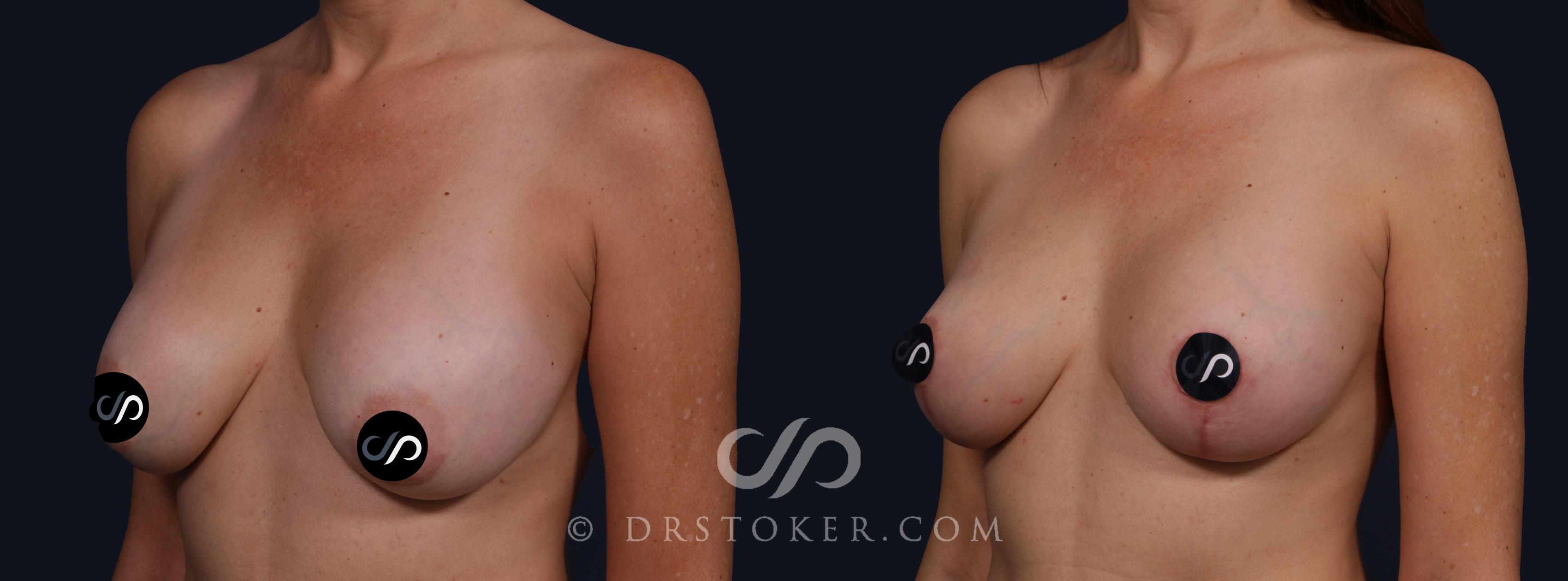 Before & After Breast Lift Case 2140 Left Oblique View in Los Angeles, CA
