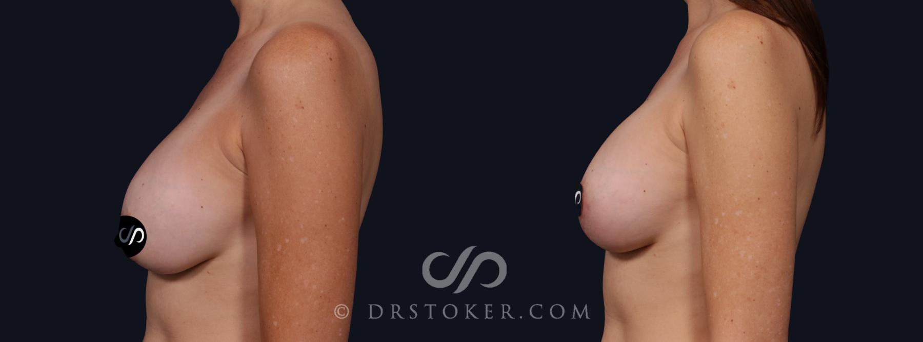 Before & After Breast Lift Case 2140 Left Side View in Los Angeles, CA