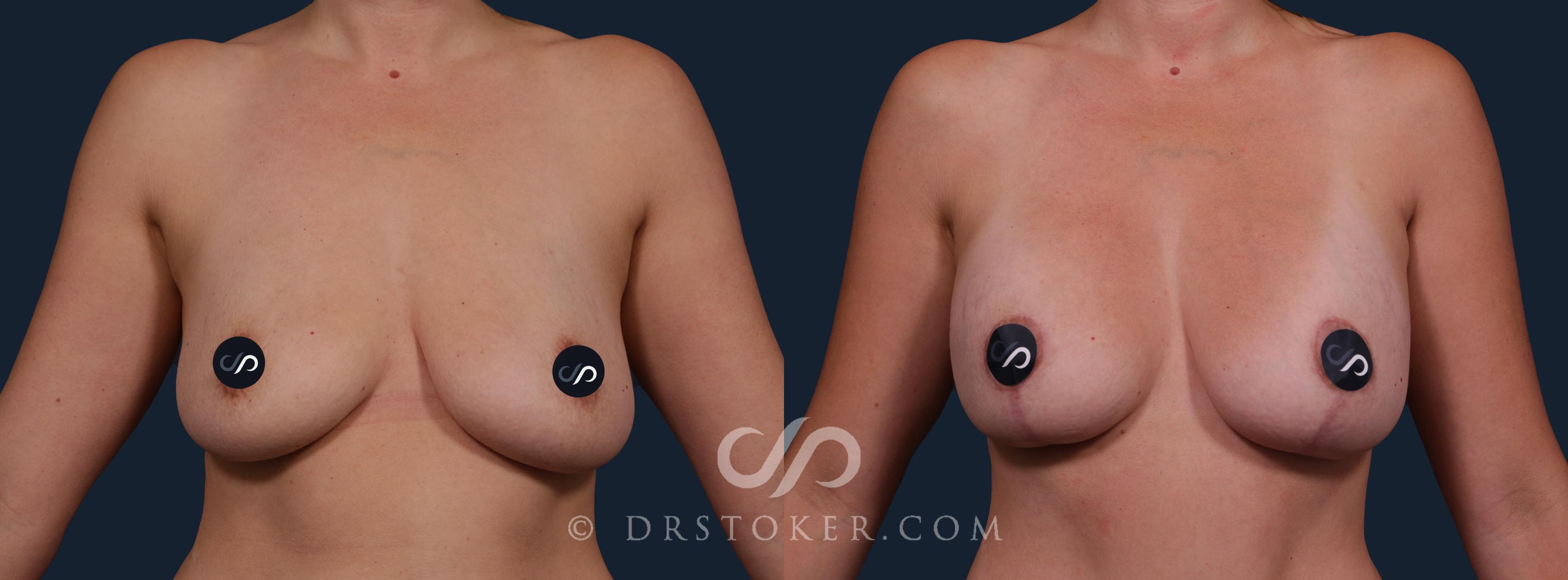 Before & After Breast Augmentation with Lift Case 2173 Front View in Los Angeles, CA