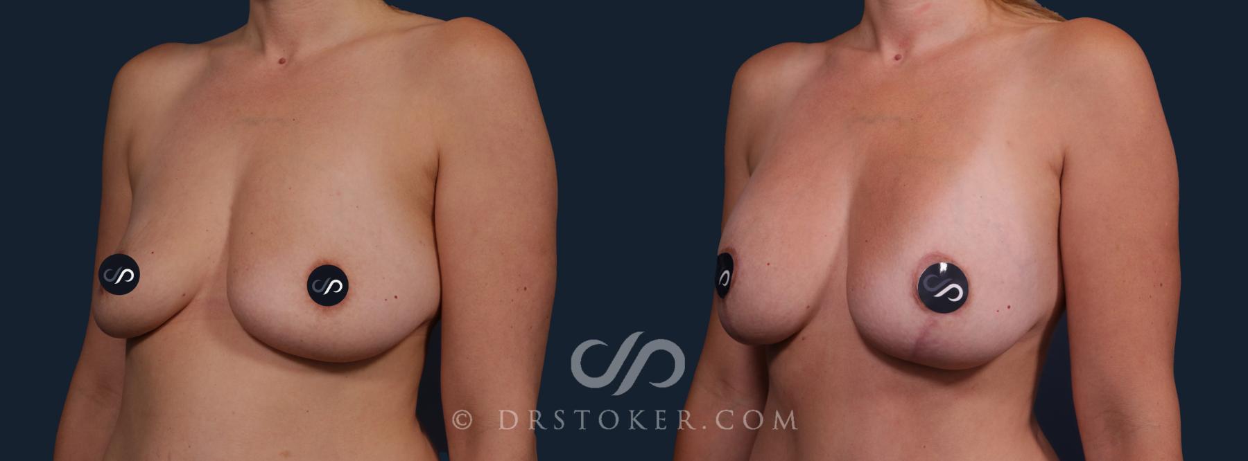 Before & After Breast Lift Case 2173 Left Oblique View in Los Angeles, CA