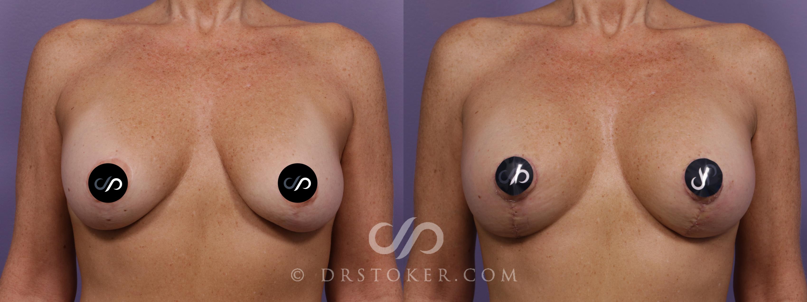 Before & After Breast Augmentation with Lift Case 2338 Front View in Los Angeles, CA