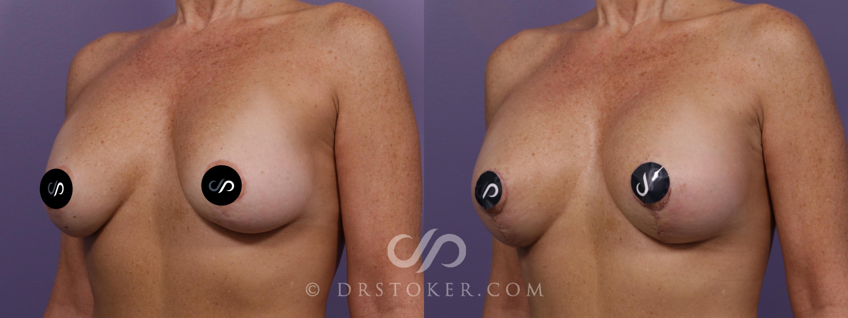 Before & After Breast Augmentation with Lift Case 2338 Left Oblique View in Los Angeles, CA