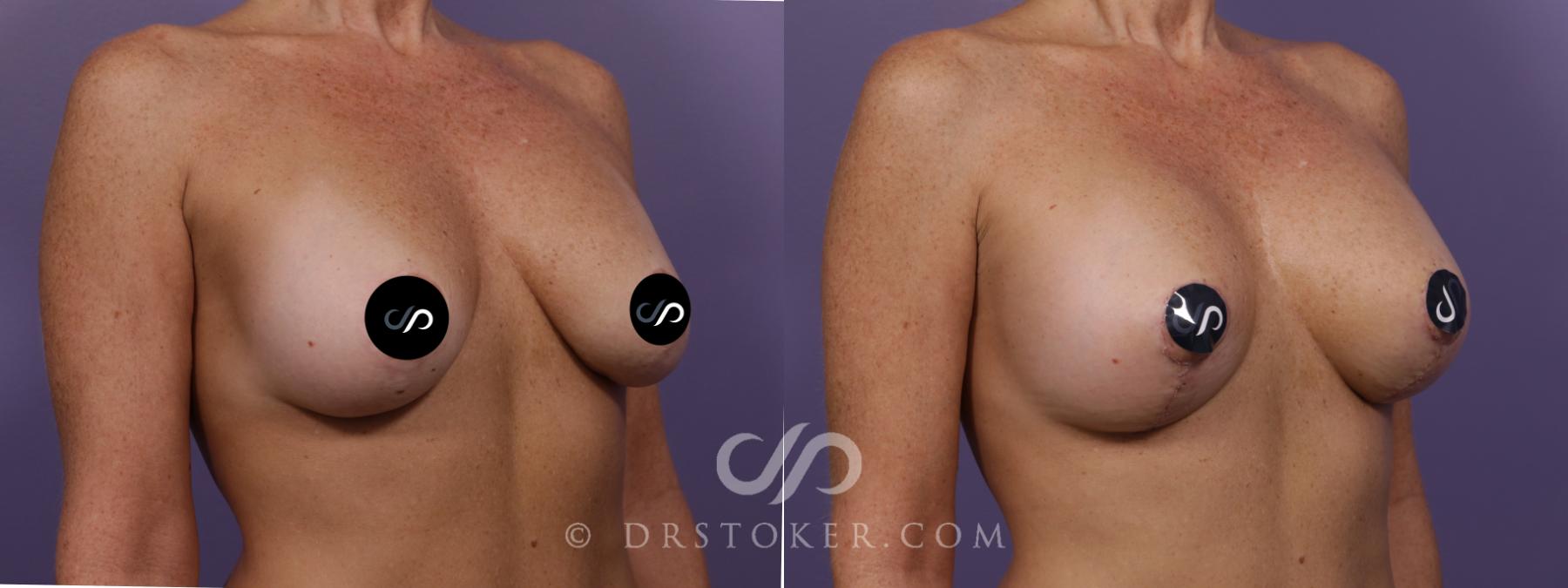 Before & After Breast Augmentation with Lift Case 2338 Right Oblique View in Los Angeles, CA