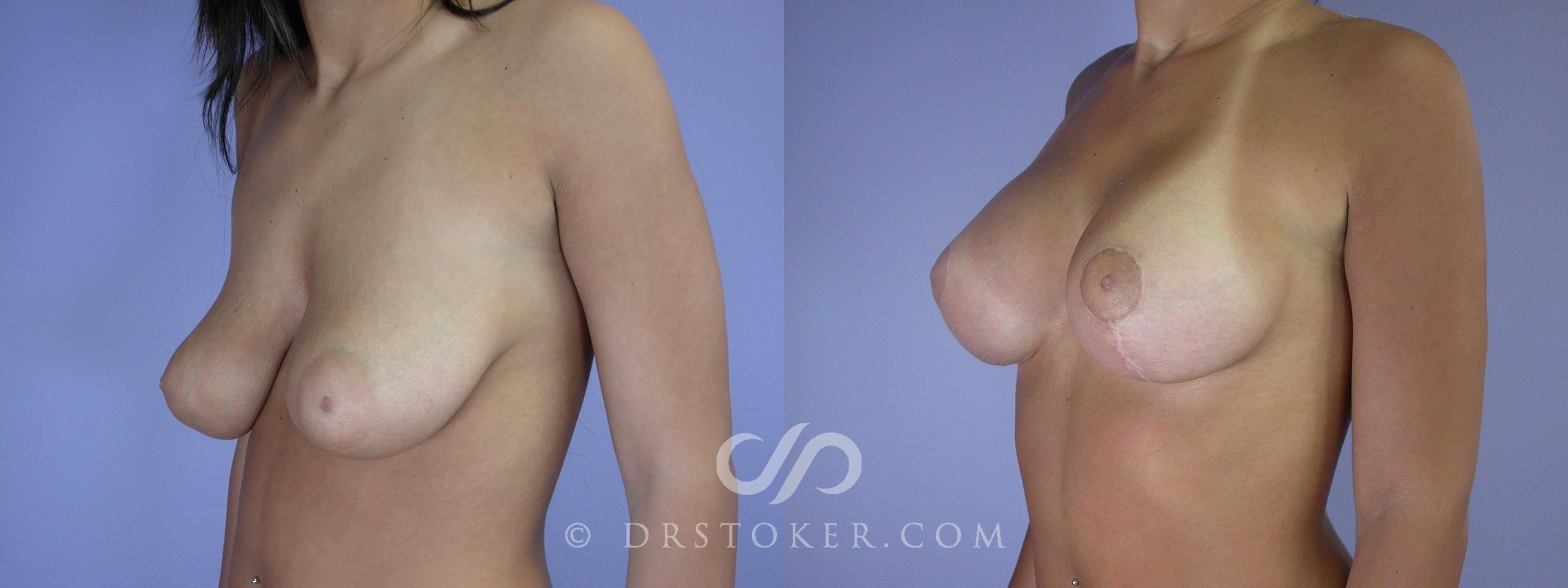 Before & After Breast Augmentation with Lift Case 2390 Left Oblique View in Los Angeles, CA
