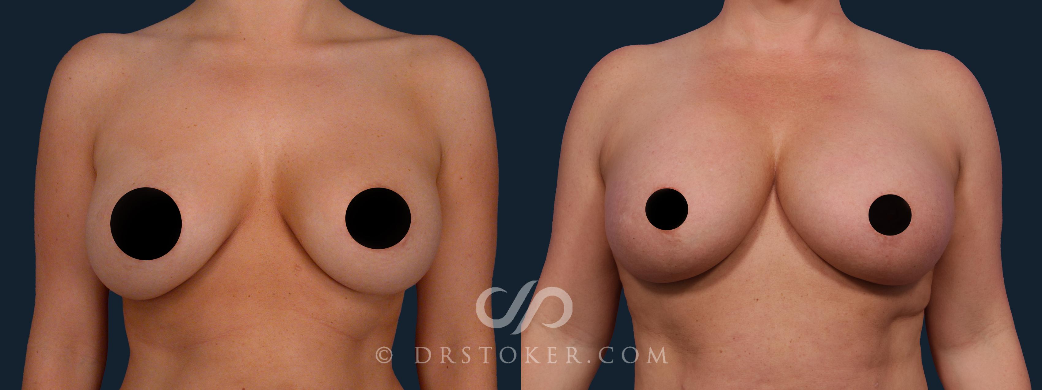 Before & After Breast Augmentation with Lift Case 2391 Front View in Los Angeles, CA