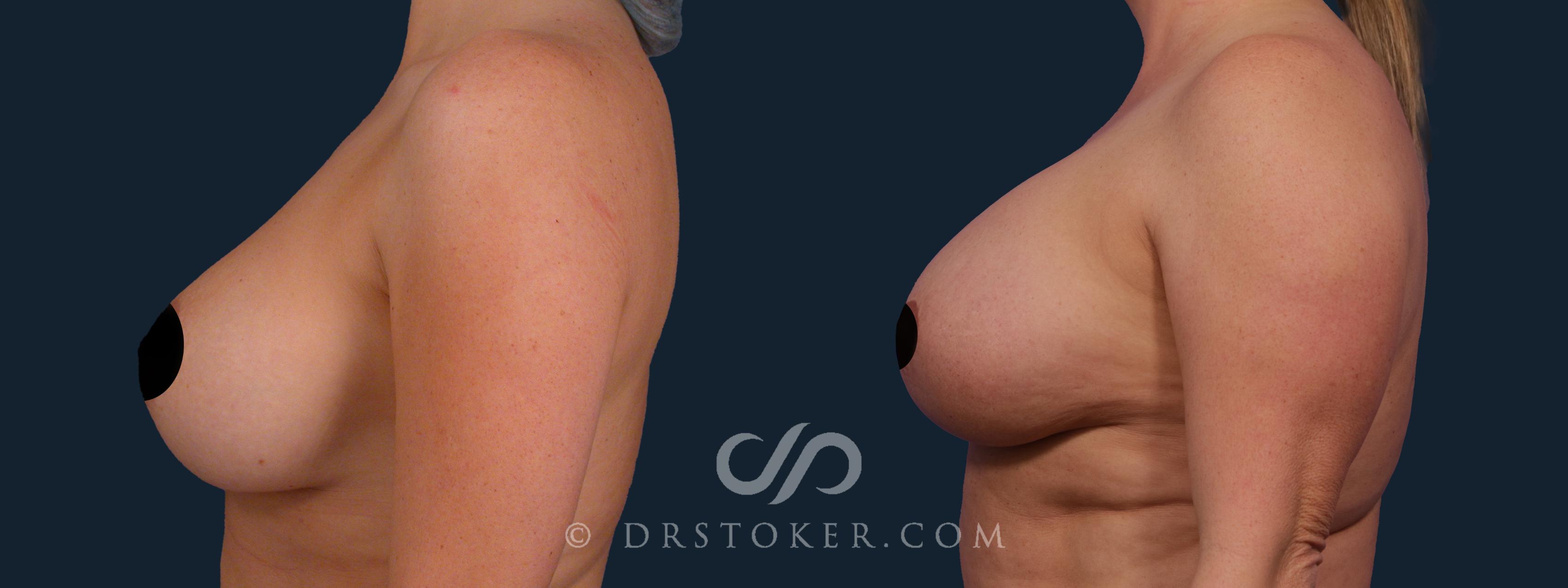 Before & After Breast Augmentation with Lift Case 2391 Left Side View in Los Angeles, CA
