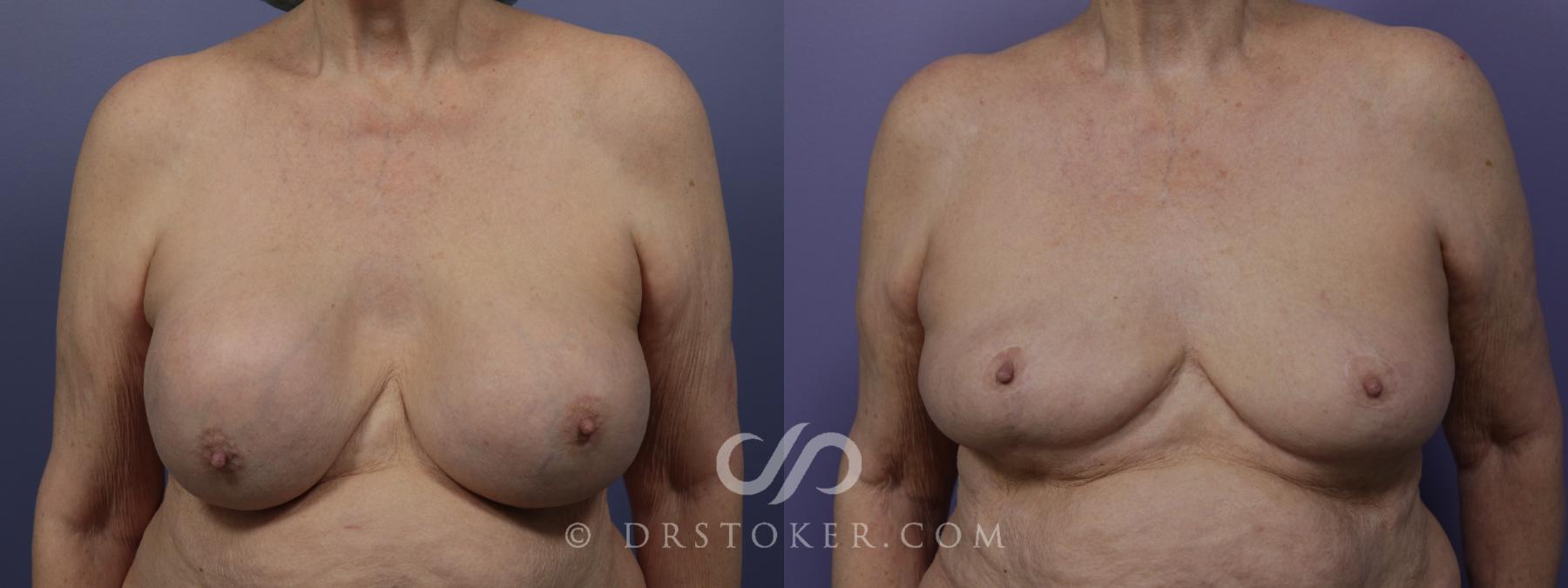 Before & After Breast Implant Correction Case 1276 View #1 View in Los Angeles, CA