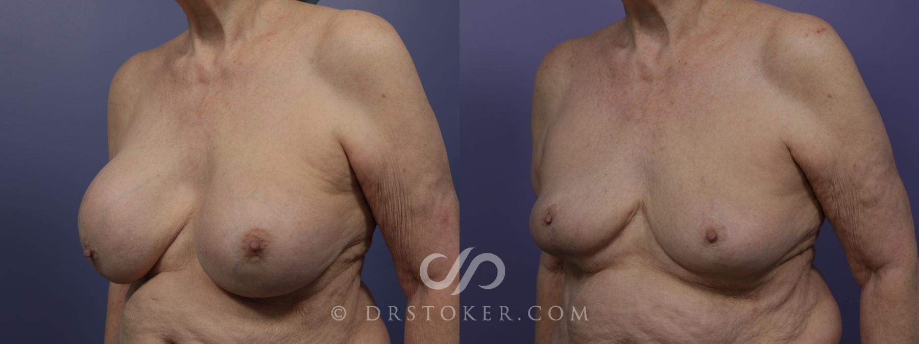 Before & After Breast Reduction (for Women) Case 1276 View #2 View in Los Angeles, CA