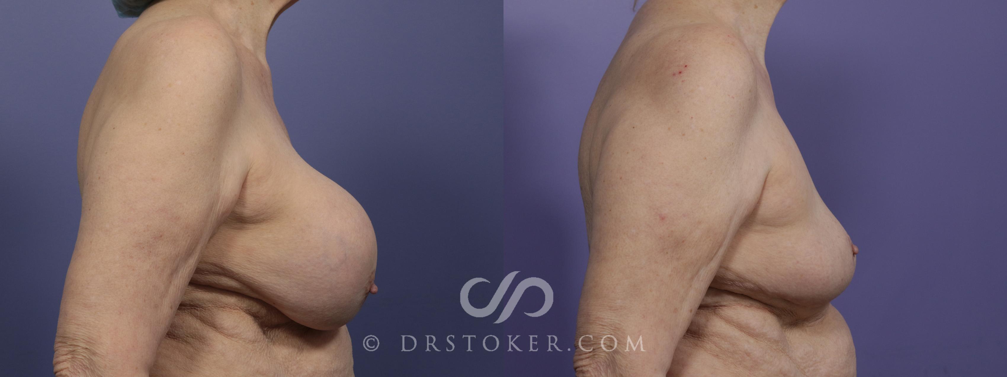 Before & After Breast Implant Correction Case 1276 View #3 View in Los Angeles, CA