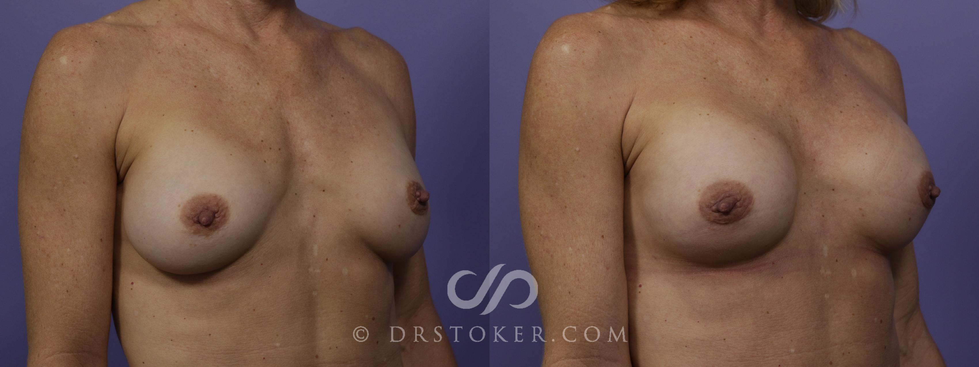 Before & After Breast Implant Correction Case 1518 View #2 View in Los Angeles, CA