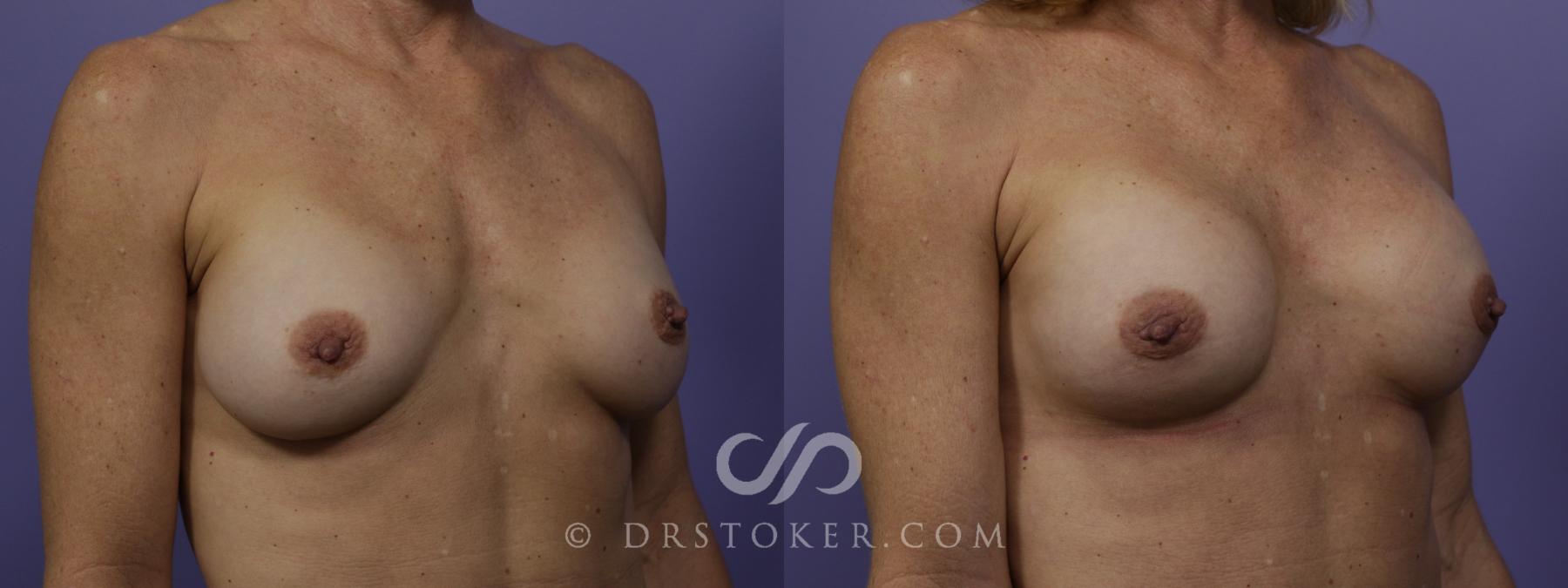 Before & After Breast Implant Correction Case 1518 View #2 View in Los Angeles, CA