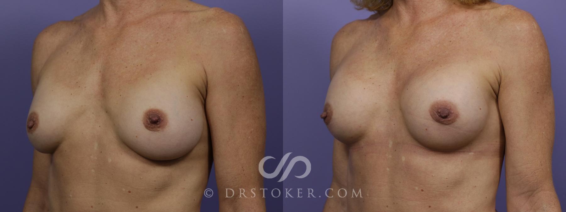 Before & After Breast Implant Correction Case 1518 View #4 View in Los Angeles, CA