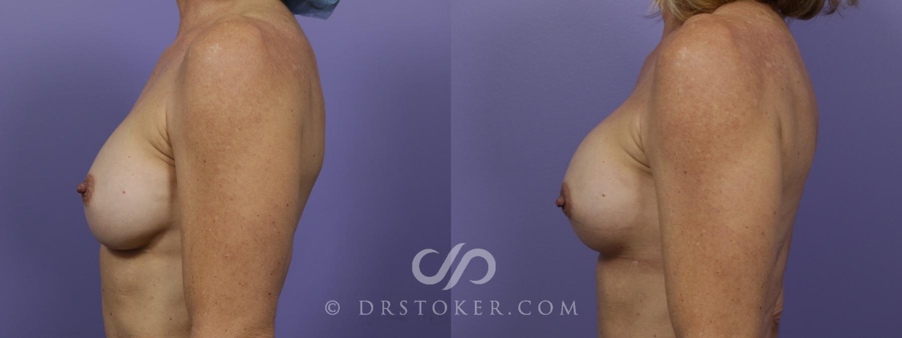 Before & After Breast Implant Correction Case 1518 View #5 View in Los Angeles, CA