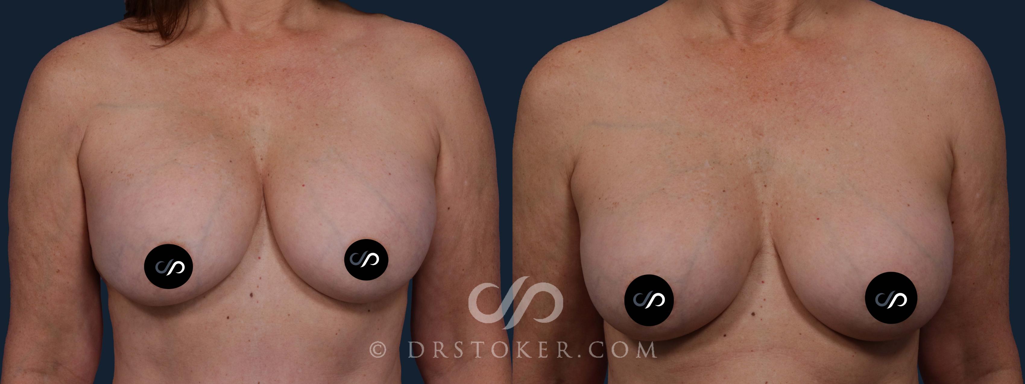Before & After Breast Implant Correction Case 1907 Front View in Los Angeles, CA