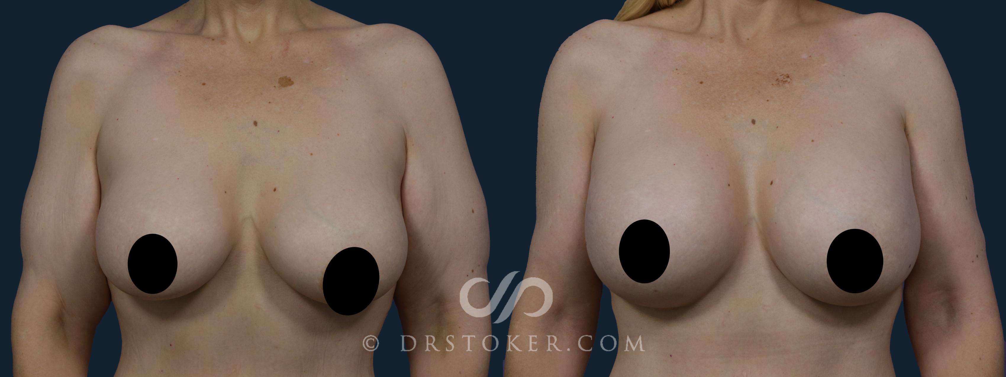 Before & After Breast Implant Correction Case 1947 Front View in Los Angeles, CA