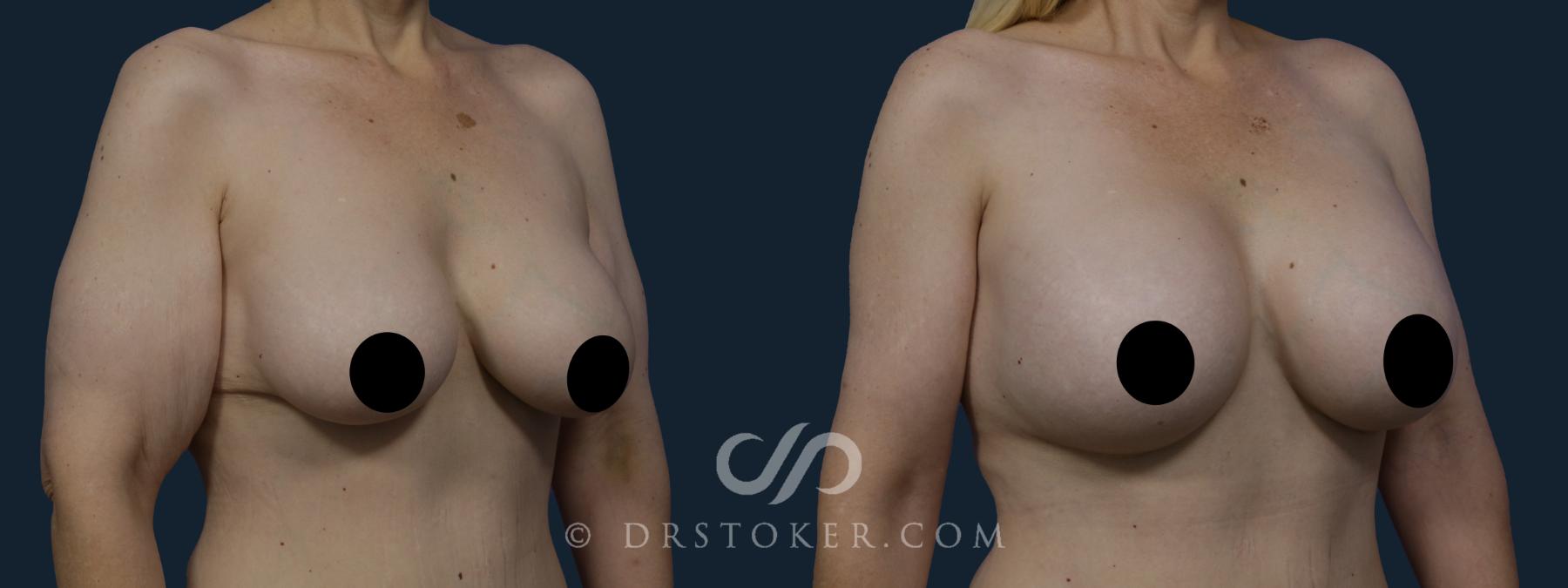 Before & After Breast Implant Correction Case 1948 Right Oblique View in Los Angeles, CA