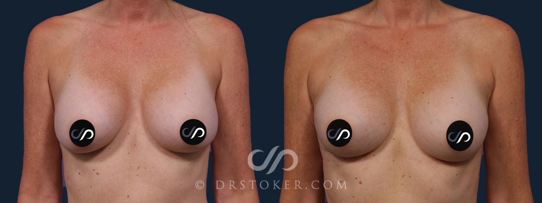 Before & After Breast Implant Correction Case 1965 Front View in Los Angeles, CA