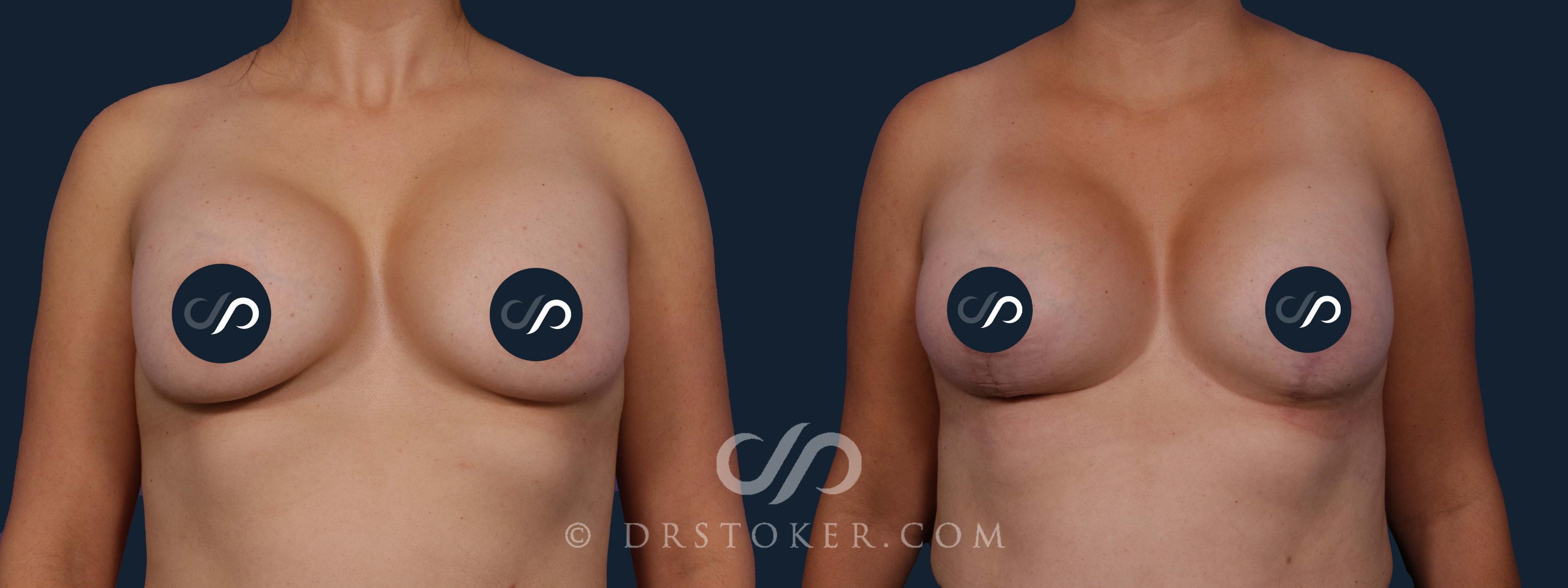 Before & After Breast Implant Correction Case 1972 Front View in Los Angeles, CA