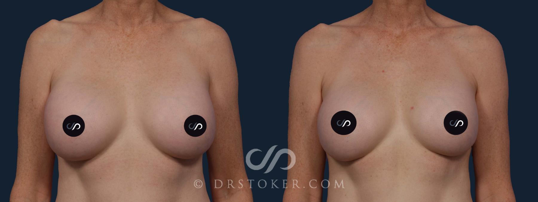 Before & After Breast Implant Correction Case 2011 Front View in Los Angeles, CA
