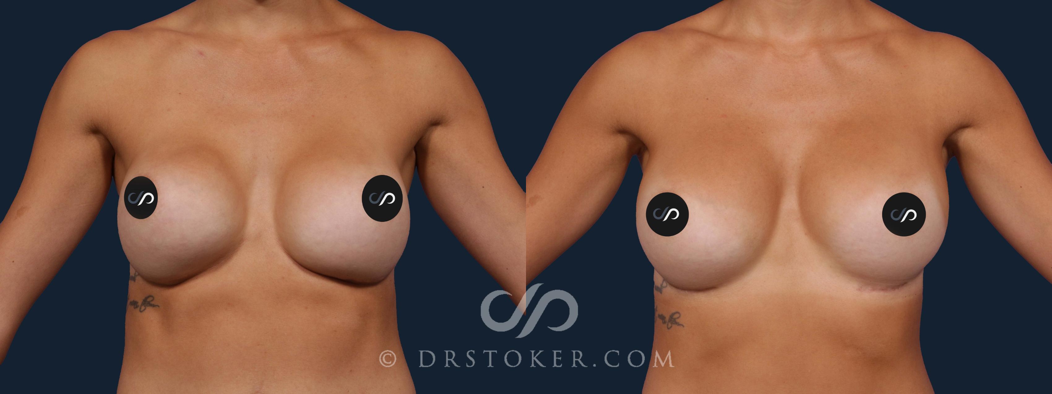 Before & After Breast Implant Correction Case 2020 Front View in Los Angeles, CA