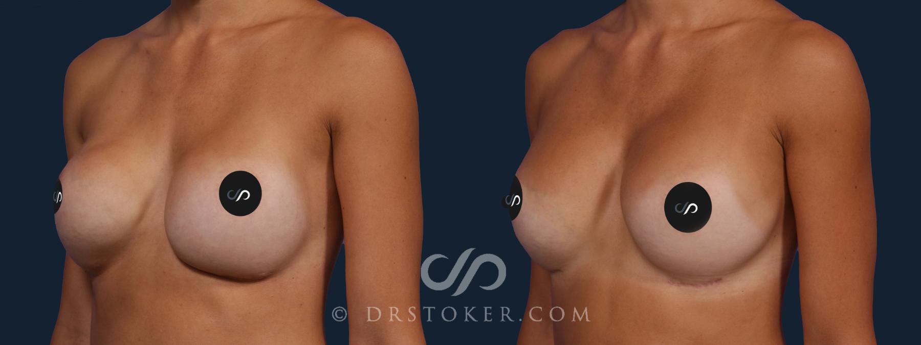 Before & After Breast Implant Correction Case 2020 Left Oblique View in Los Angeles, CA