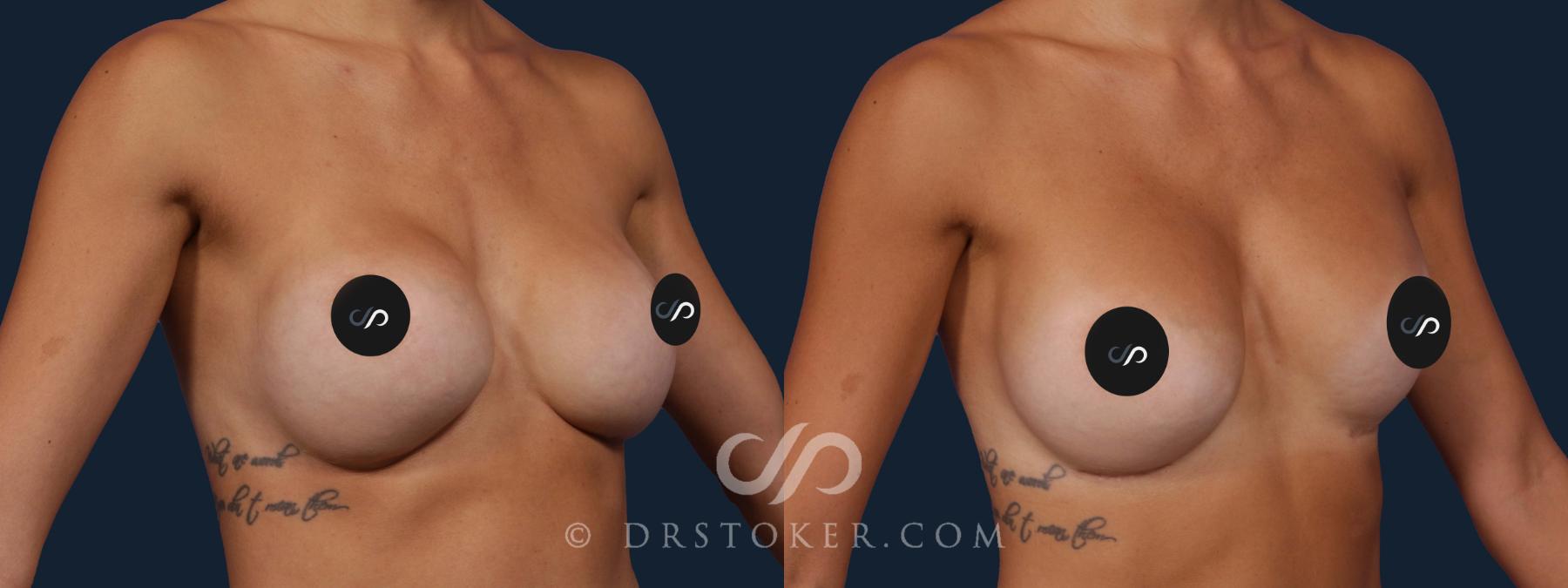 Before & After Breast Implant Correction Case 2020 Right Oblique View in Los Angeles, CA
