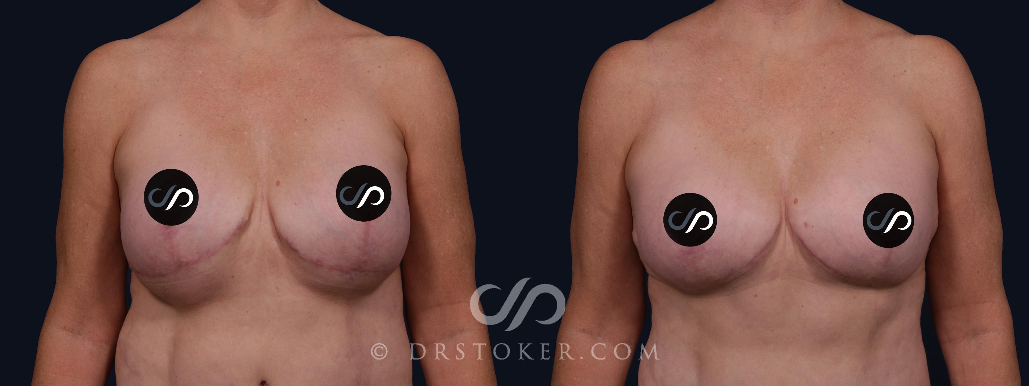 Before & After Breast Implant Correction Case 2071 Front View in Los Angeles, CA