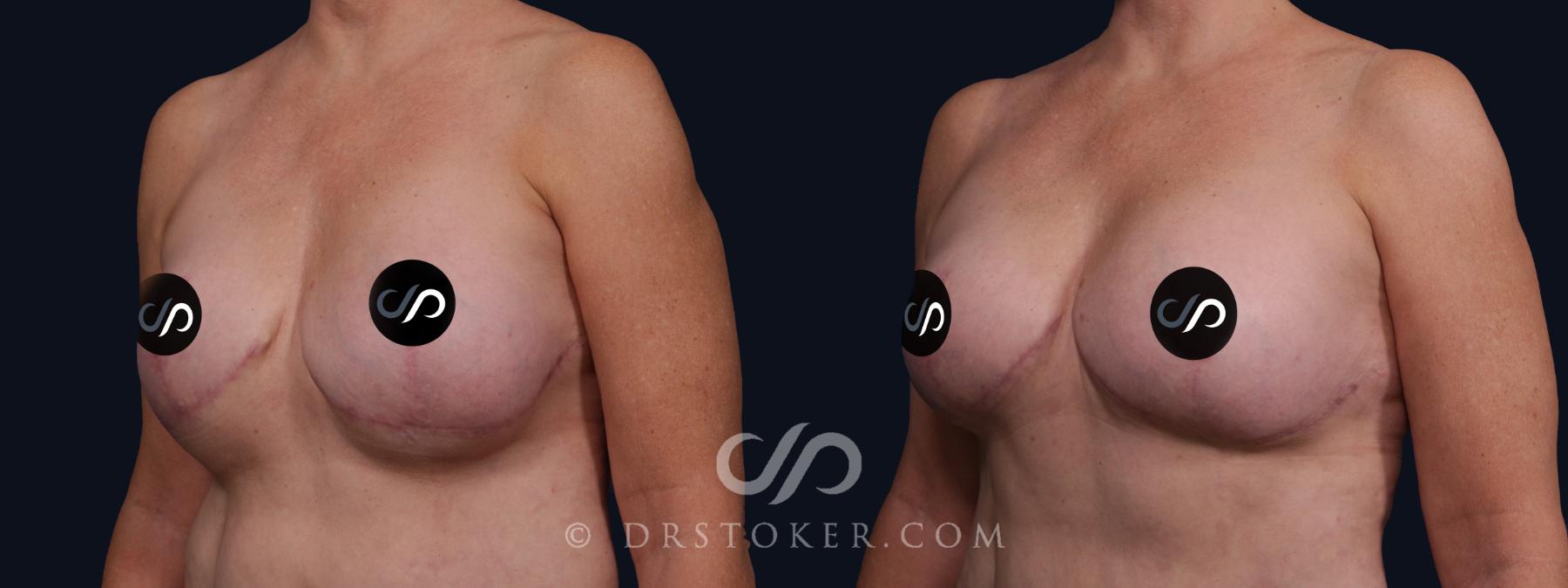 Before & After Breast Implant Correction Case 2071 Left Oblique View in Los Angeles, CA